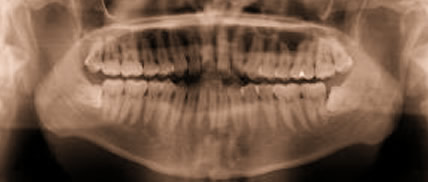panorama dental x-ray